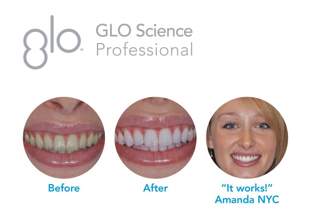 glo teeth whitening review